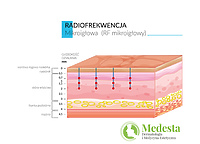 Fala radiowa frakcyjna mikroigłowa MRF - nowa technologia na zmarszczki i blizny