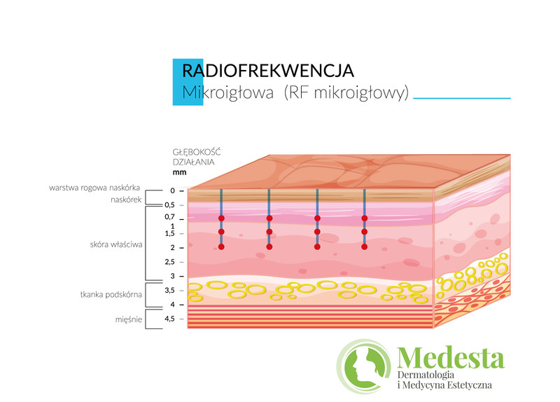 Fala radiowa frakcyjna mikroigłowa MRF - nowa technologia na zmarszczki i blizny