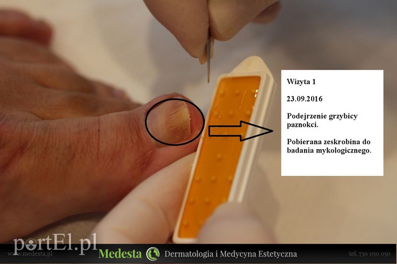 Elbląg Piękne stopy: laser Lunula na grzybicę paznokci