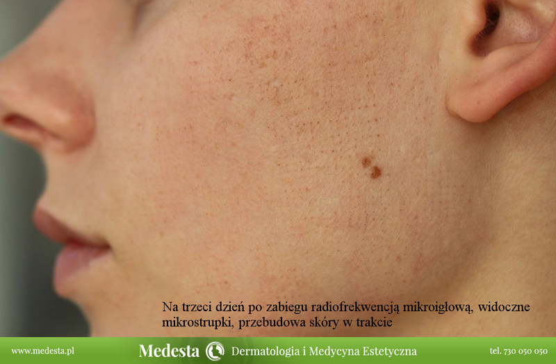 Usuwanie blizn i zmarszczek różnymi metodami zdjęcie nr 162592