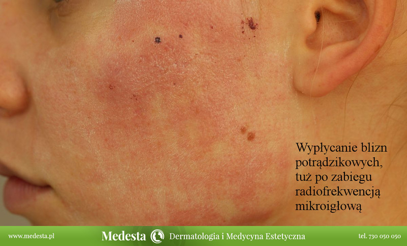 Usuwanie blizn i zmarszczek różnymi metodami zdjęcie nr 162591