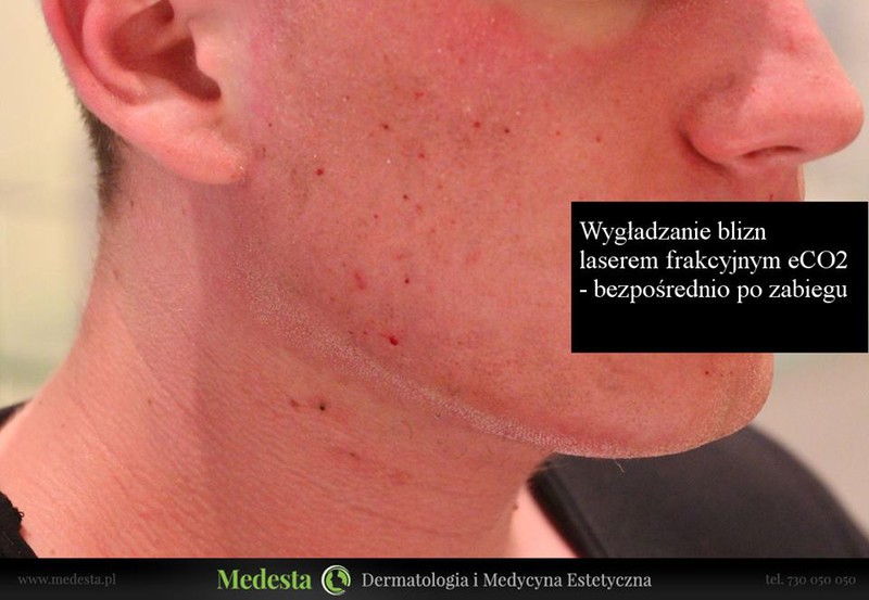 Usuwanie blizn i zmarszczek różnymi metodami zdjęcie nr 162589