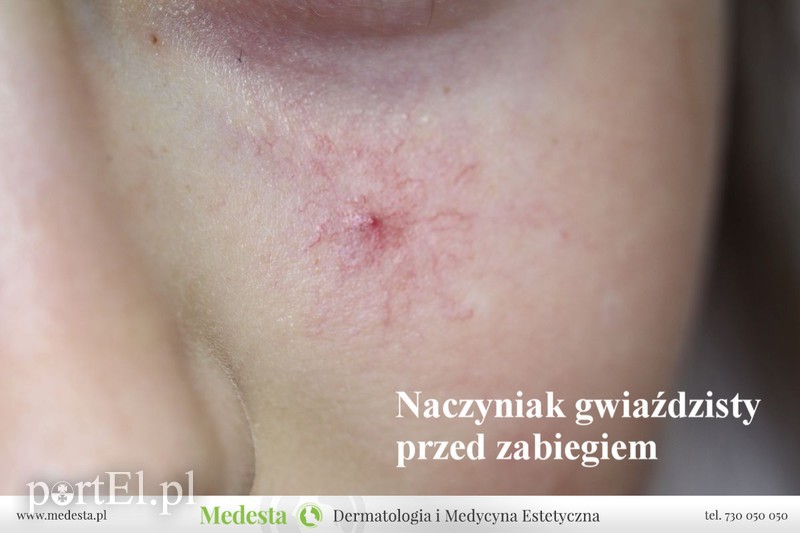 Jedyny w Elblągu laser na rumień i rozszerzone naczynka na twarzy i nogach zdjęcie nr 170866