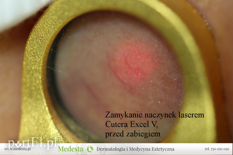 Jedyny w Elblągu laser na rumień i rozszerzone naczynka na twarzy i nogach zdjęcie nr 170864