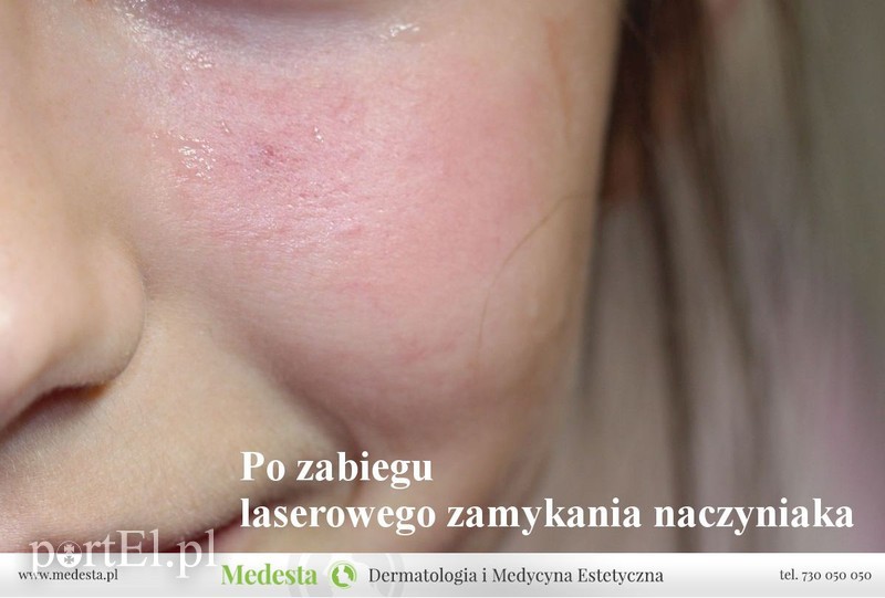 Jedyny w Elblągu laser na rumień i rozszerzone naczynka na twarzy i nogach zdjęcie nr 170867