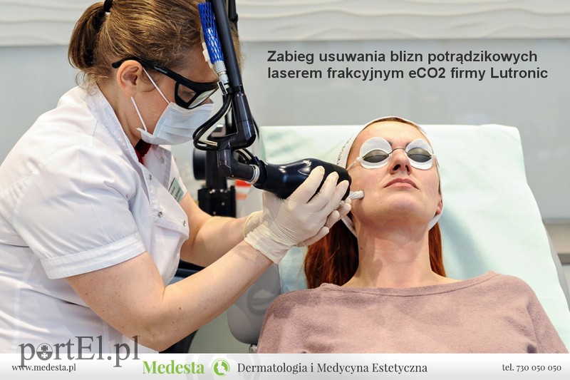 Kompleksowa terapia blizn i rozstępów w Klinice Medesta zdjęcie nr 171675