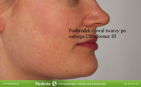 Rzeczywiste rezultaty zabiegów w Klinice Medesta