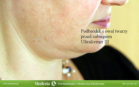 Usuwanie blizn i zmarszczek różnymi metodami