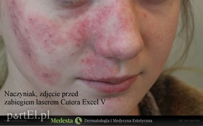Jedyny w Elblągu laser na rumień i rozszerzone naczynka na twarzy i nogach
