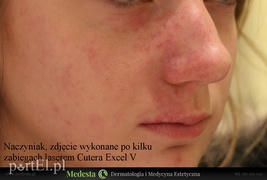 Jedyny w Elblągu laser na rumień i rozszerzone naczynka na twarzy i nogach