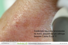Jedyny w Elblągu laser na rumień i rozszerzone naczynka na twarzy i nogach