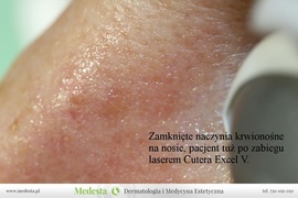 Skuteczne usuwanie pajączków laserem Cutera Excel V